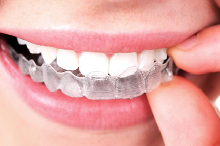 invisalign